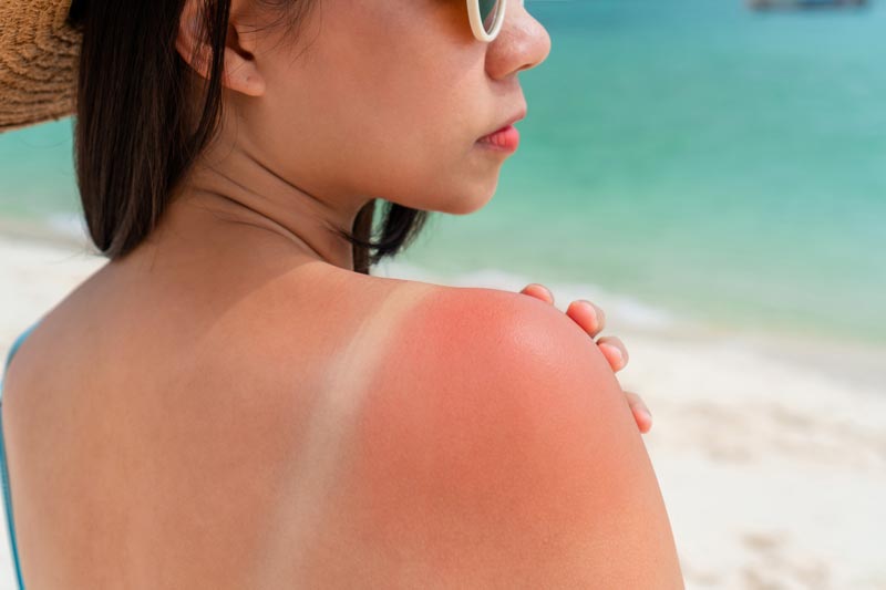 Jeune femme avec un coup de soleil